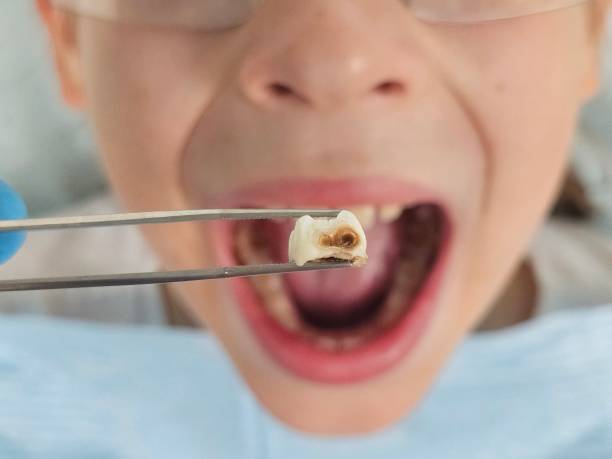 Best Emergency Treatment for Oral Infections in Wray, CO
